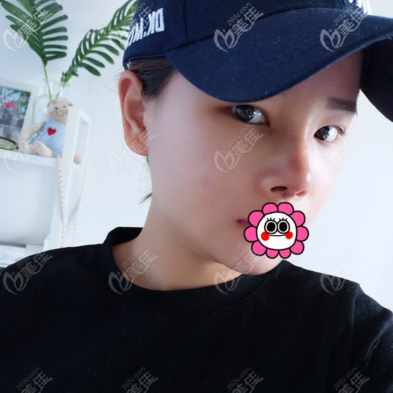 半肋骨隆鼻术后7天拆线 半肋骨隆鼻术后7天拆线