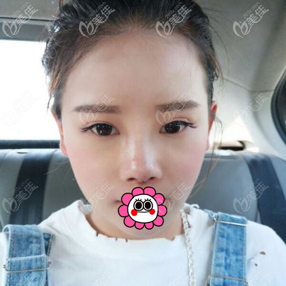 半肋骨鼻整形恢复半个月效果 半肋骨鼻整形恢复半个月效果