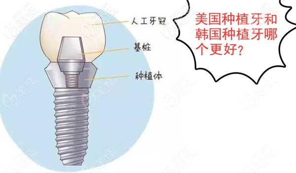 美国种植牙和韩国种植牙哪个更好