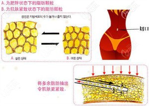 腰腹吸脂手术