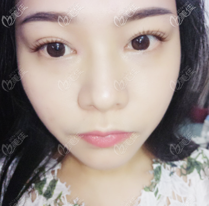 广州军美<!--<i data=20240703-sp></i>-->医生做的双眼皮恢复 广州军美<!--<i data=20240703-sp></i>-->医生做的双眼皮恢复