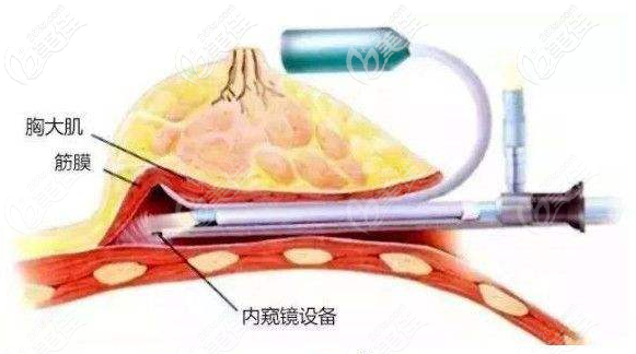 内窥镜隆胸 内窥镜隆胸