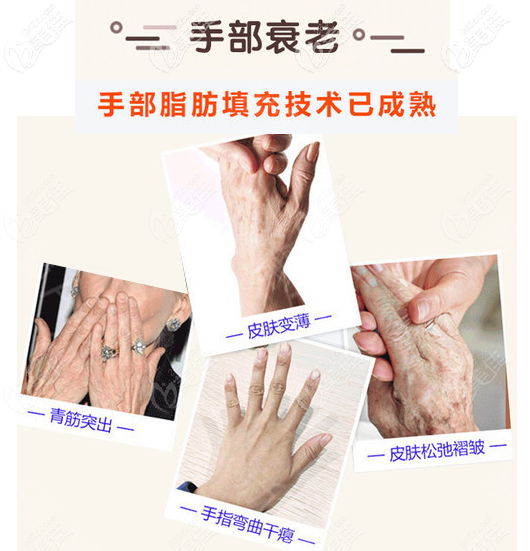 手背和手指可以做自体脂肪填充 手背和手指可以做自体脂肪填充