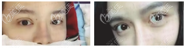 生物焊接双眼皮案例效果 生物焊接双眼皮案例效果