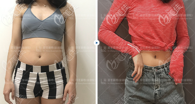 重庆郑荃丽格A4体雕机瘦腰腹效果