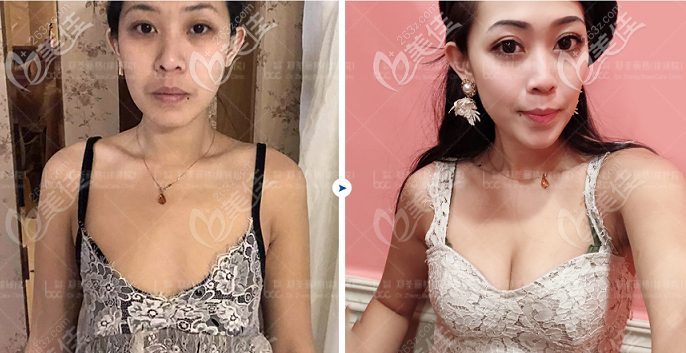 徐铎自体脂肪丰胸案例