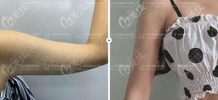 重庆5G天使光雕手臂吸脂效果