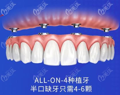 all-on-4半口种植 all-on-4半口种植