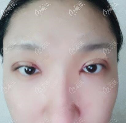 埋线双眼皮术后第3天