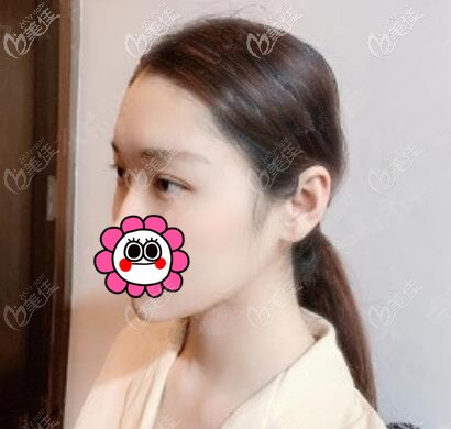 微创埋线双眼皮术后第7天