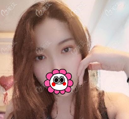 埋线双眼皮术后第15天效果