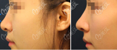 玻尿酸隆鼻前后一个月的对比照片 玻尿酸隆鼻前后一个月的对比照片