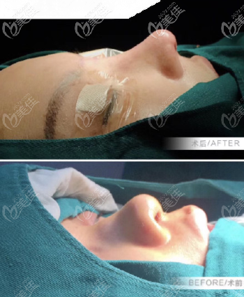 <!--<i data=20240703-sp></i>-->膨体+半肋鼻综合案例