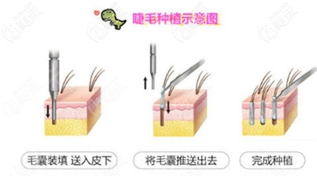 睫毛种植过程示意图 睫毛种植过程示意图