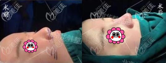 北京华韩王义山院长鼻综合真人案例 北京华韩王义山院长鼻综合真人案例