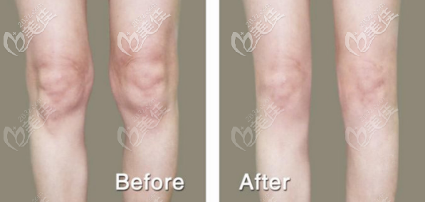 张清峰grl紧肤体雕对比张艳华ss脂肪体雕术