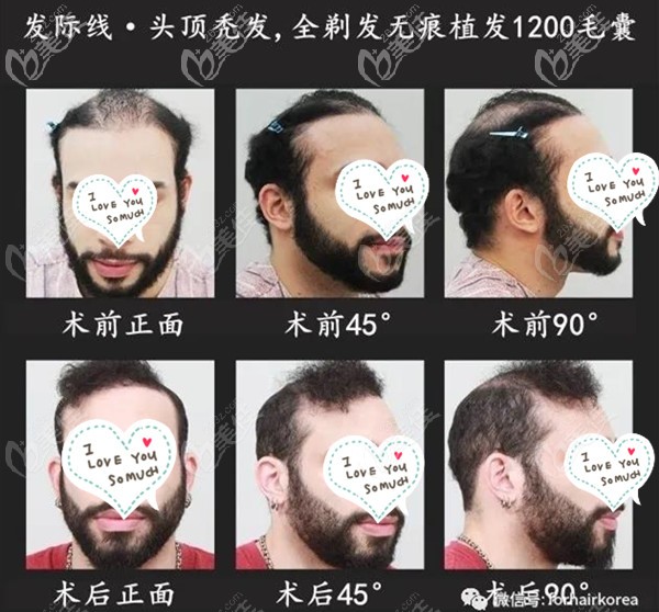 韩国FORHAIR植发络腮胡植发案例 韩国FORHAIR植发络腮胡植发案例