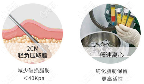 北京南加脂肪胶丰胸的优势 北京南加脂肪胶丰胸的优势