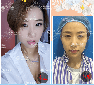 北京彤美做双眼皮怎么样?刘风卓切开双眼案例效果参考 北京彤美做双眼皮怎么样?刘风卓切开双眼案例效果参考