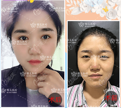 我找桂行军做眼综合案例效果给你参考北京彤美谁做眼睛好 我找桂行军做眼综合案例效果给你参考北京彤美谁做眼睛好