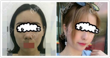 我做合资艳冠假体隆鼻一年后效果图片分享给大家 我做合资艳冠假体隆鼻一年后效果图片分享给大家