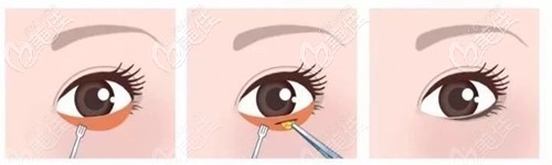 去眼袋手术过程