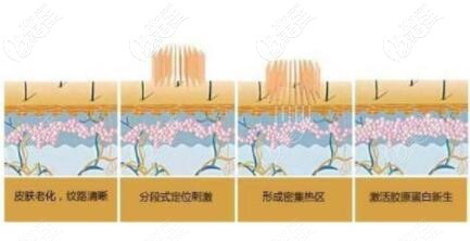 点阵激光治疗黑头的原理 点阵激光治疗黑头的原理