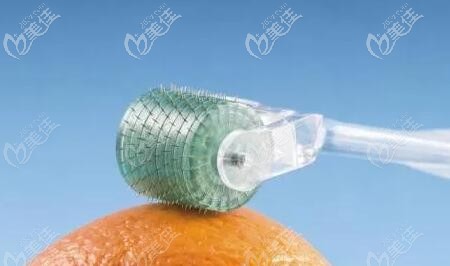 微针治疗皮肤黑头的原理 微针治疗皮肤黑头的原理