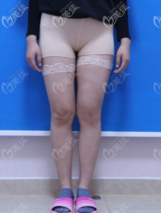 术前的我大腿 术前的我大腿