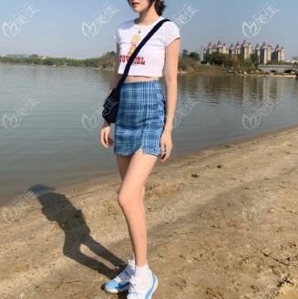 新疆黎美大腿吸脂术后一个月 新疆黎美大腿吸脂术后一个月