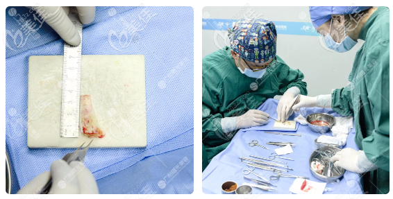 广州曙光王旭明鼻修复过程图 广州曙光王旭明鼻修复过程图