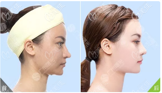 广州曙光王旭明鼻综合隆鼻子案例 广州曙光王旭明鼻综合隆鼻子案例