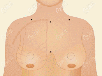 缩胸手术的部位 缩胸手术的部位