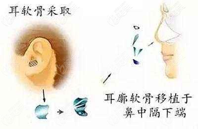 自体耳软骨隆鼻材料