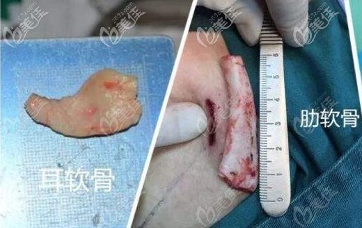 耳软骨隆鼻和肋骨隆鼻材料的对比