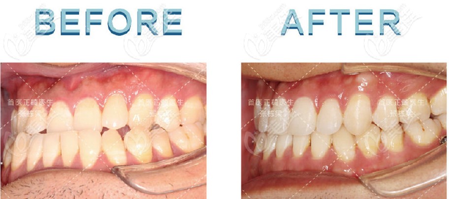 地包天用舌侧隐形矫正牙齿的改善情况