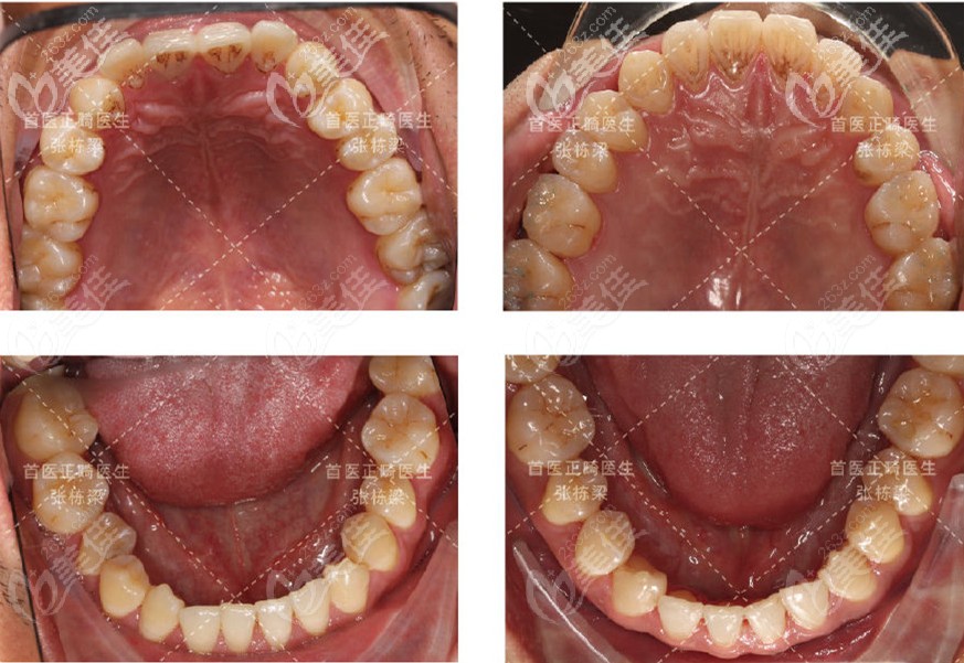 上下颌牙齿都有所改善，且没有牙齿出现脱矿的情况