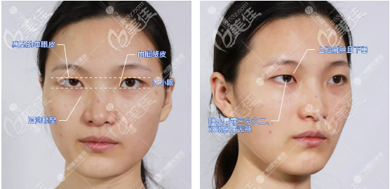 来广州曙光做双眼皮术前自拍 来广州曙光做双眼皮术前自拍