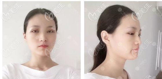 杨晓英医生双眼皮术后3天恢复效果 杨晓英医生双眼皮术后3天恢复效果