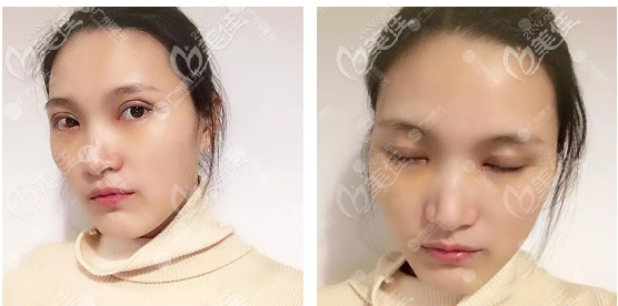 双眼皮恢复过程7天自拍 双眼皮恢复过程7天自拍