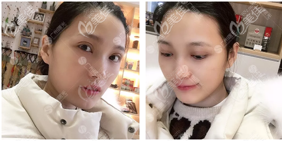 杨晓英医生双眼皮案例半个月反馈 杨晓英医生双眼皮案例半个月反馈