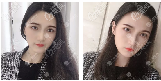 广州曙光杨晓英医生做双眼皮怎么样 广州曙光杨晓英医生做双眼皮怎么样