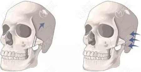 磨骨手术过程 磨骨手术过程