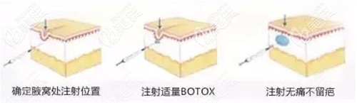 注射去狐臭的原理 注射去狐臭的原理