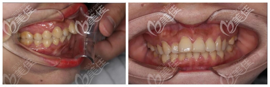 北京牙管家牙列拥挤案例 北京牙管家牙列拥挤案例