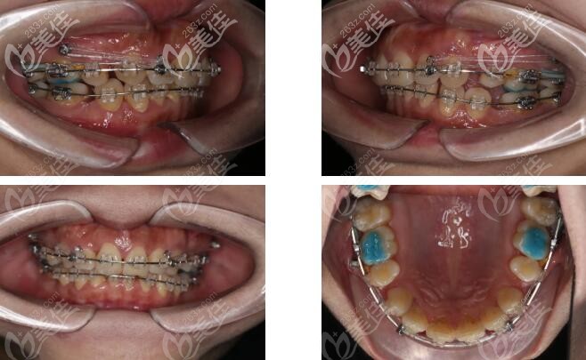 全口mbt直丝弓矫正图片 全口mbt直丝弓矫正图片