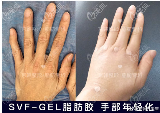 北京京韩乔爱军脂肪胶填充手背手指案例对比图 北京京韩乔爱军脂肪胶填充手背手指案例对比图
