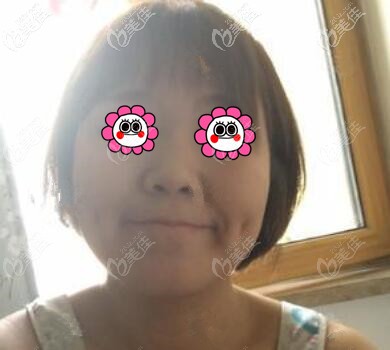 做鼻综合术前照 做鼻综合术前照