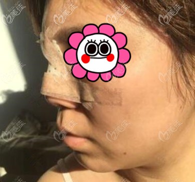 鼻整形术后第2天情况 鼻整形术后第2天情况