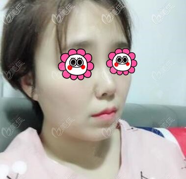 做鼻整形半个月的恢复效果照 做鼻整形半个月的恢复效果照